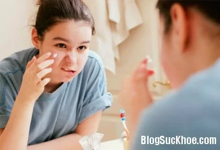 Bạn đã trị mụn đúng cách chưa?