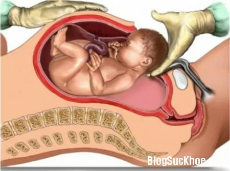 Những điều cần biết khi sinh mổ
