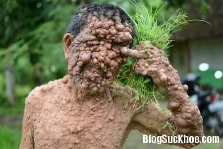 Nổi u khắp người do bệnh lạ