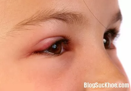 Viêm bờ mi mắt - Căn bệnh không nên chủ quan