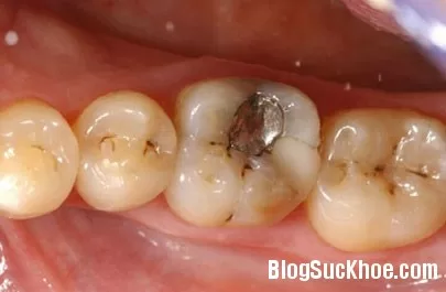 Điều trị và phòng ngừa bệnh sâu răng