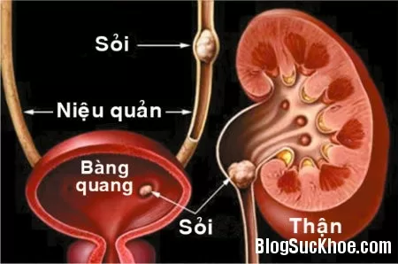 Triệu chứng và cách phòng bệnh sỏi tiết niệu