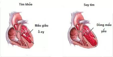 Suy tim - Dấu hiệu của nhiều bệnh