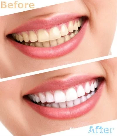 Những điều cần biết khi tẩy trắng răng