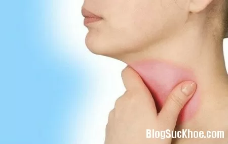 Một số thủ thuật đơn giản chữa viêm họng ngay tại nhà