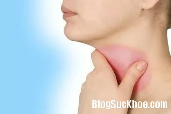 Mẹo hay giúp giảm chứng đau họng