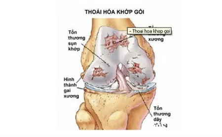 Bệnh thoái hóa khớp ở giới trẻ
