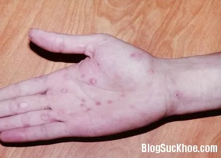Nguyên nhân, phòng ngừa và điều trị bệnh lậu
