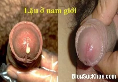 Phòng và điều trị bệnh lậu