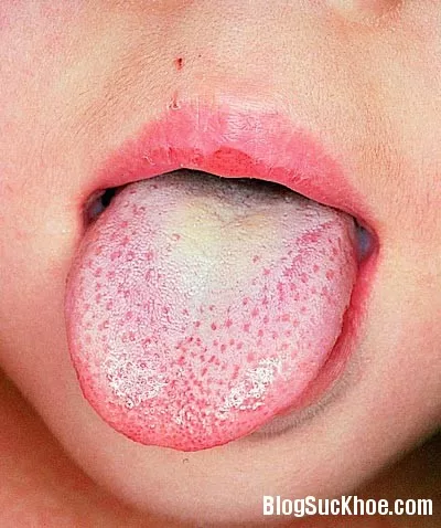 Lưỡi đóng bợn trắng, dấu hiệu của bệnh