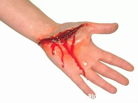 Sơ cứu khi bị chảy máu
