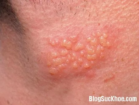 Bệnh Herpes sinh dục