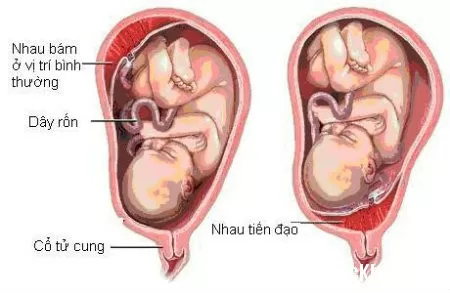 Những nguy hại về nhau tiền đạo