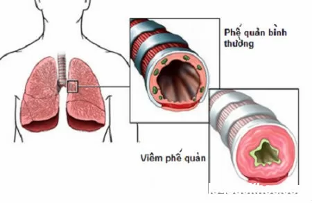 Triệu chứng bệnh viêm phế quản cấp