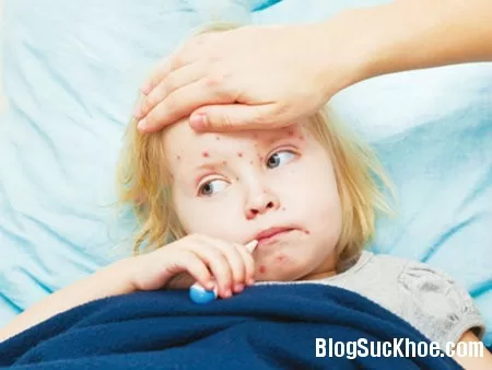 18 điều mẹ cần biết về sởi