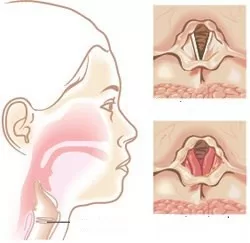 Không nên xem thường khi bị khàn tiếng