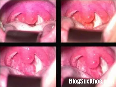 Viêm họng cấp - Bệnh hay gặp lúc thời tiết chuyển mùa