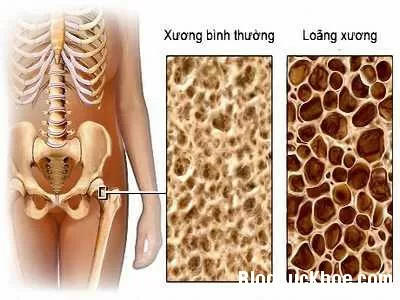 Dấu hiệu lâm sàng bệnh xốp xương