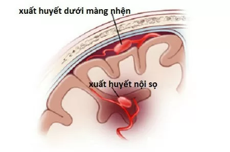 Bệnh lý xuất huyết não dạng bột