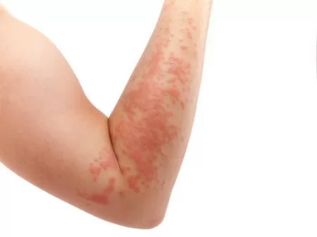 Người mắc bệnh eczema có thể tránh được bệnh ung thư da
