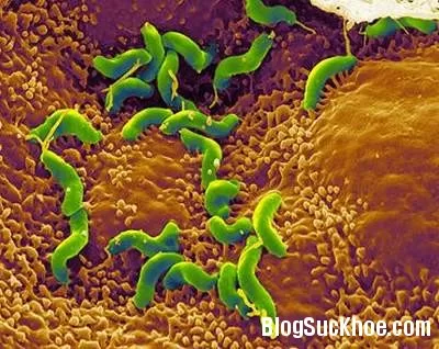 Nhiễm H.pylori – Hậu quả nghiêm trọng