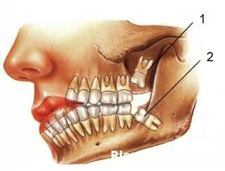 Cách giảm đau khi mọc răng khôn