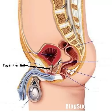 Điều trị u xơ tiền liệt tuyến