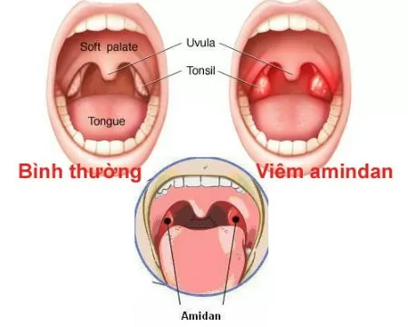 Phương pháp phòng ngừa viêm amidan