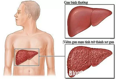 Cách phòng chống bệnh gan