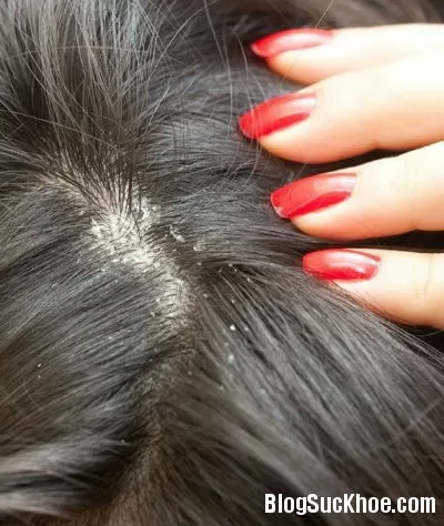 Bệnh gàu và cách trị gàu