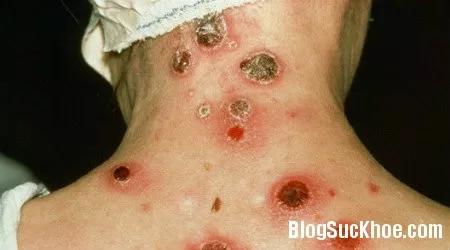 3 giai đoạn phát triển của giang mai