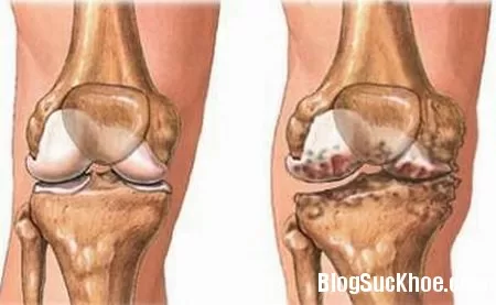 Nguyên nhân và cách điều trị bệnh khô khớp