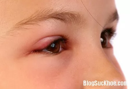 Các dấu hiệu nhận biết mắt bé có vấn đề