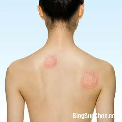 Cách phòng trị 5 loại bệnh nấm da thường gặp