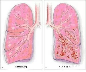 Điều trị bệnh giãn phế quản