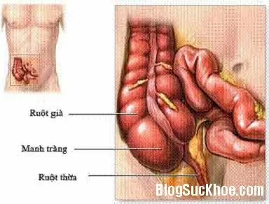 Biến chứng khi cắt ruột thừa: sớm, muộn và dấu hiệu cần khám lại