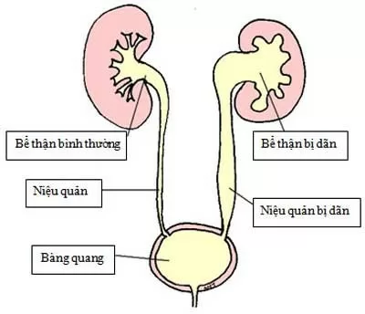 Điều trị thận ứ nước ở trẻ sơ sinh