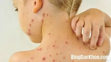 Phòng ngừa biến chứng do thủy đậu