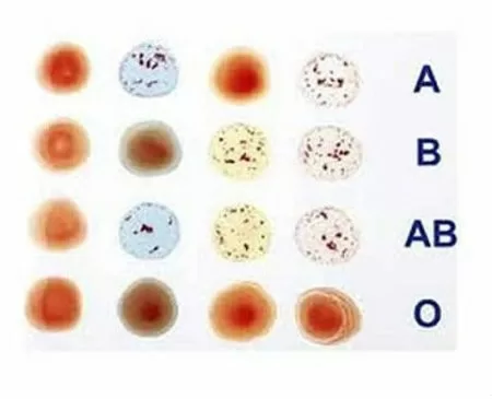 Nhóm máu nào dễ mắc bệnh ung thư?