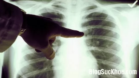 10 dấu hiệu cảnh báo sớm ung thư phổi