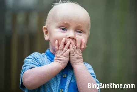 Bệnh vảy nến ở trẻ
