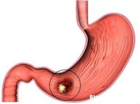 3 dấu hiệu của bệnh viêm loét dạ dày