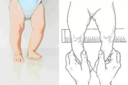 Phòng tránh chân vòng kiềng cho bé