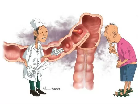 Những thực phẩm có khả năng ngăn ngừa ung thư đại tràng