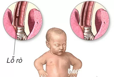 Biểu hiện sớm của teo thực quản