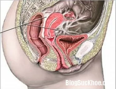 Hiện tượng dính trong ổ bụng