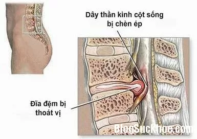 Bệnh thoát vị đĩa đệm và cách chữa trị