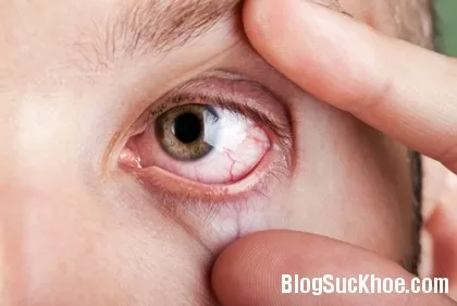 Bệnh lý về mắt do bệnh đái tháo đường gây nên