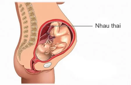 Nguyên nhân và triệu chứng bong nhau non