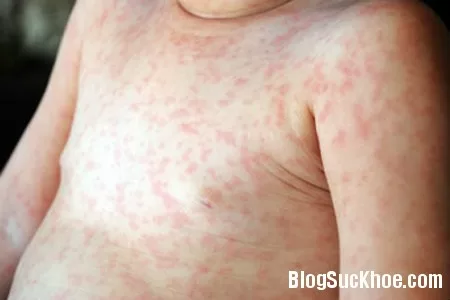 Các triệu chứng và nguyên nhân bệnh sốt phát ban